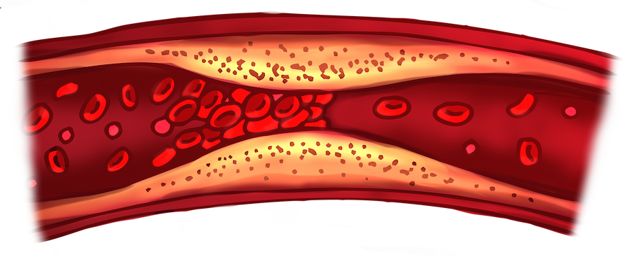 complicaciones-cardiovasculares complicaciones-cardiovasculares
