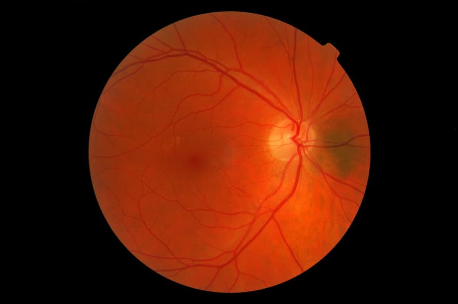 complicaciones-oculares-retina complicaciones-oculares-retina