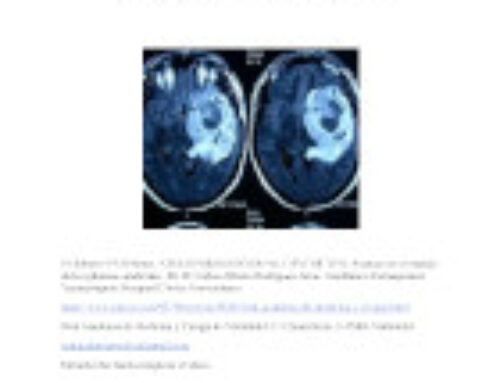Avances en el manejo de los gliomas cerebrales